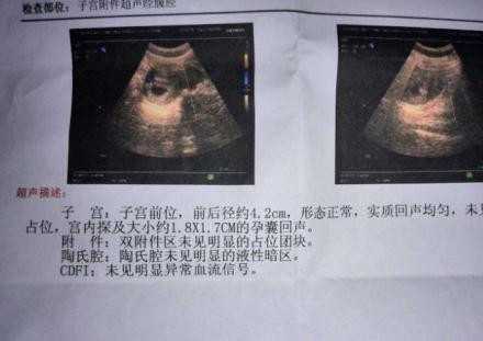 鹤壁现在还代孕吗_鹤壁代孕哪一个医院好_试管婴儿会比自然分娩的孩子差吗？